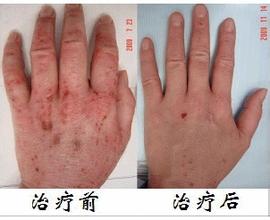 华医堂治疗手藓效果