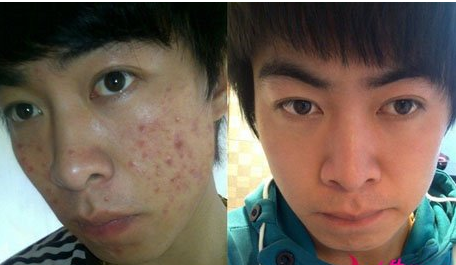 治疗痘痘前后对比图