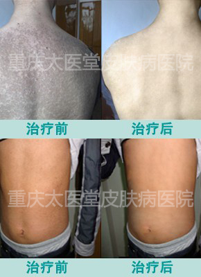 治疗鱼鳞病效果图