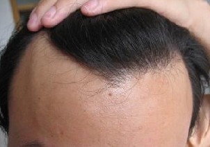 突然脱发的原因是什么