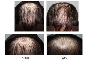 脱发治疗过程