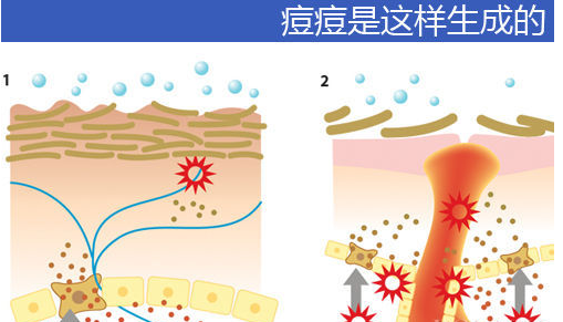 青春痘